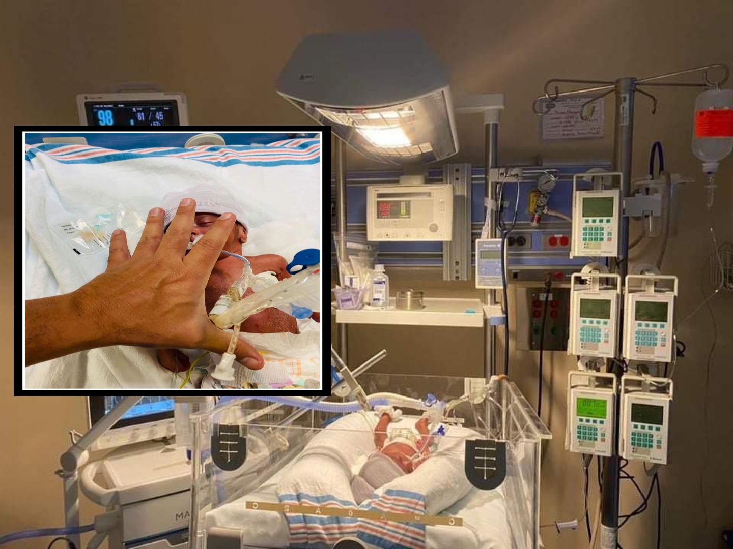 Medicos del Hospital Materno Infantil de Irapuato, salvan vida de bebé prematuro con diagnóstico de cardiopatía congénita. 1